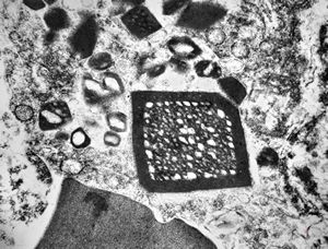 M,58y. | spleen - thesaurismosis of unknown origin … postmedicamentous? M,58y. | spleen - thesaurismosis of unknown origin … postmedicamentous?